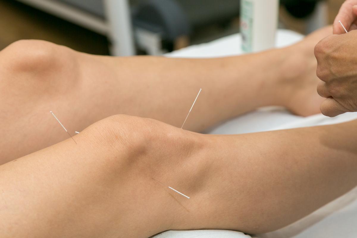 needling-physios-02